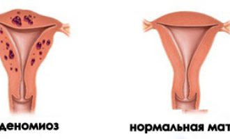 Аденомиоз матки