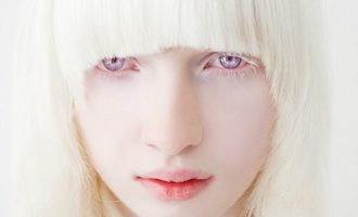 Альбинизм у человека
