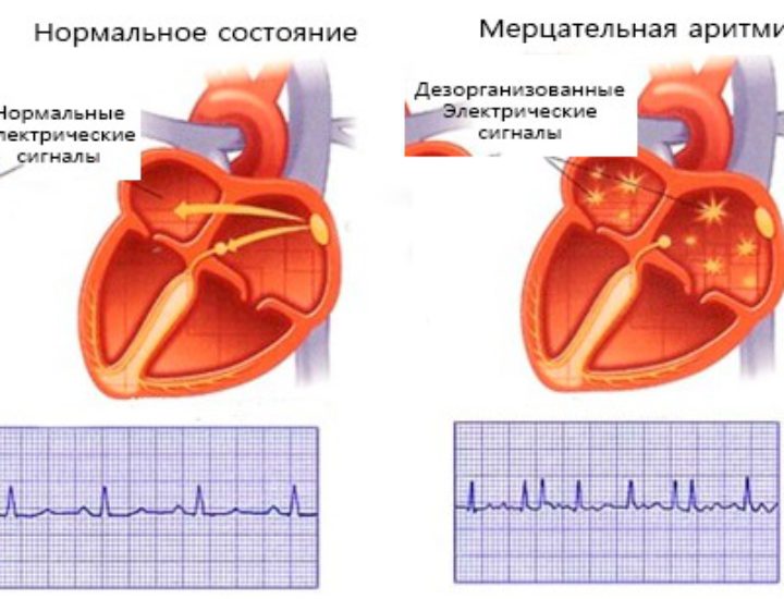 Мерцательная аритмия сердца