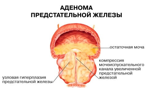 Лечение небольшой аденома предстательной железы