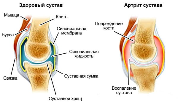 Изображение - Артрит коленного сустава причины и лечение Artrit-kolennogo-sustava-chto-eto