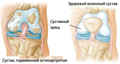 Изображение - Артрит коленного сустава причины и лечение Artrit-kolennogo-sustava-foto