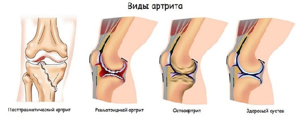 Изображение - Артрит коленного сустава причины и лечение Artrit-kolennogo-sustava-klassifikatsiya
