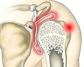 Изображение - Артрит плечевого сустава симптомы Artrit-plechevogo-sustava