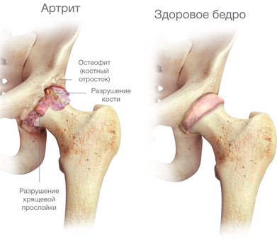 Лечение ювенильного артрита тазобедренного сустава