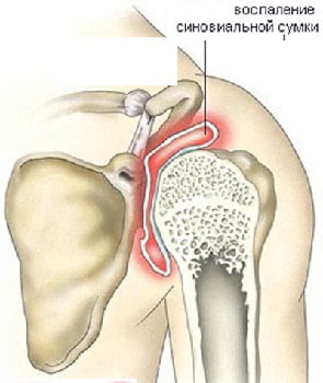 Изображение - Артроз левого плечевого сустава лечение Artroz-plechevogo-sustava-foto