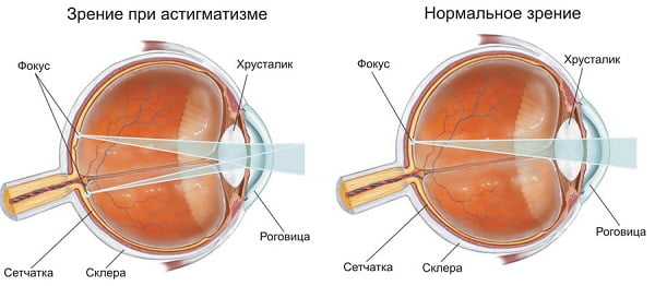 Что такое астигматизм глаз и как его лечить фото