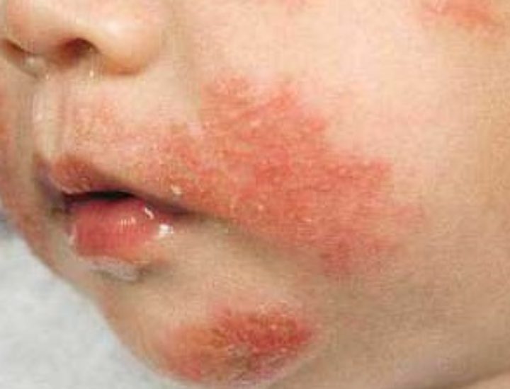 Атопический дерматит у детей