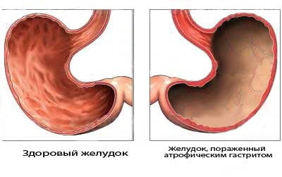 Симптомы при атрофическом гастрите желудка