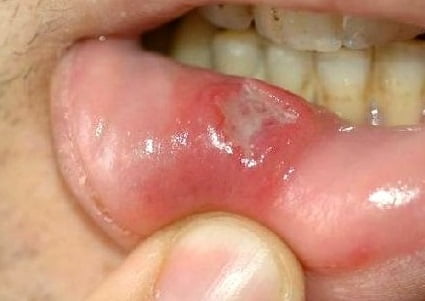 Синдром бехчета в полости рта фото thumbnail