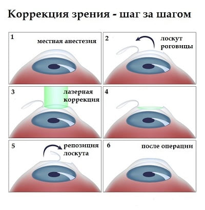Что такое астигматизм глаз и как его лечить фото thumbnail