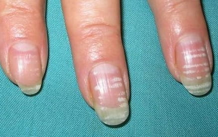 Белые пятна на ногтях. ТОП 25 причины, что означают. Приметы, к чему белые пятнышки на ногтях