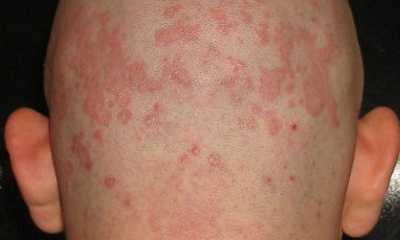 что такое дерматит на коже thumbnail