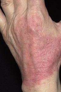 Атопический дерматит у взрослых фото на теле симптомы