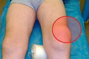 Что такое бурсит коленного сустава симптомы и лечение фото