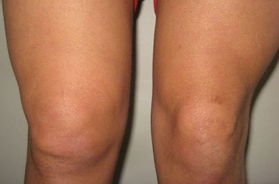 Бурсит коленного сустава лечение фото