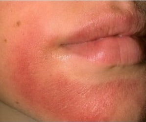 Лечение дерматита кожи тела thumbnail
