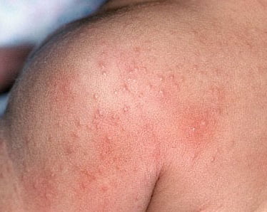 Что такое дерматиты на коже thumbnail