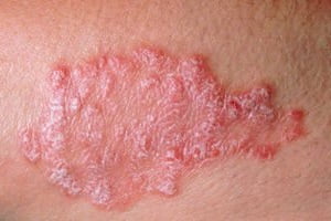Признаки дерматита пятна на теле thumbnail