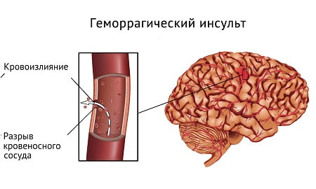 Кровоизлияние в мозг повышенное давление thumbnail