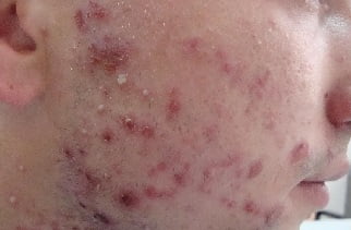 Заболевания кожи лица импетиго