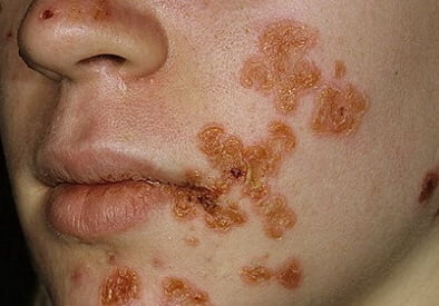 Заболевания кожи лица импетиго