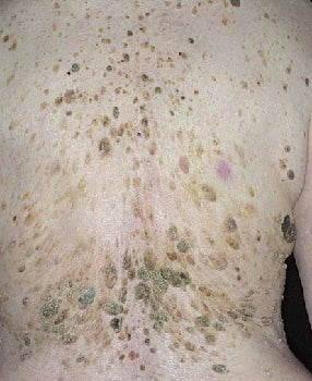 Заболевание кожи лица кератома