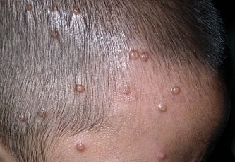 Заболевание кожи лица моллюск