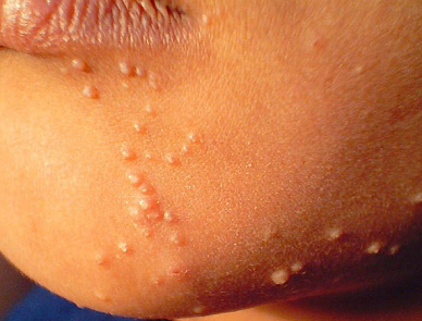Заболевание кожи лица моллюск