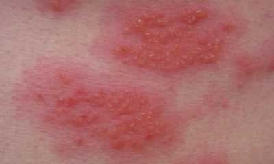 Экссудативный дерматит у взрослых лечение thumbnail