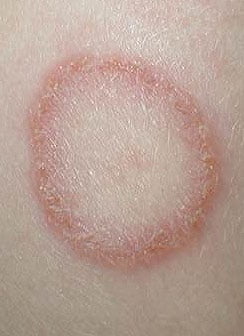 Микроспория кожи лица лечение thumbnail