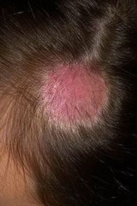 Микроспория волосистой части головы народные средства лечения