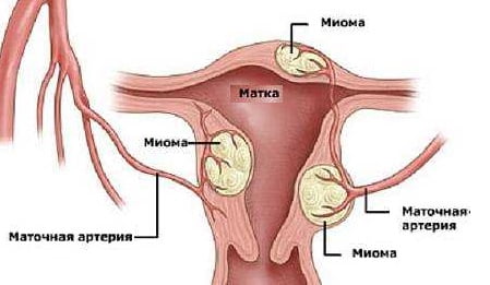 Симптомы миомы матки у женщин лечение thumbnail