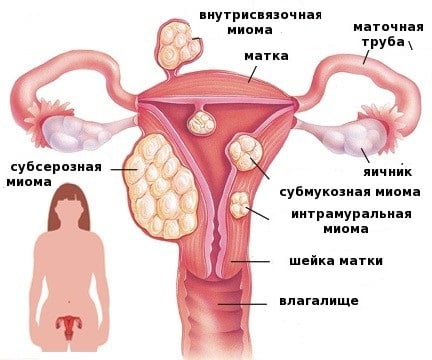 При миоме матки какие могут быть симптомы и лечение thumbnail