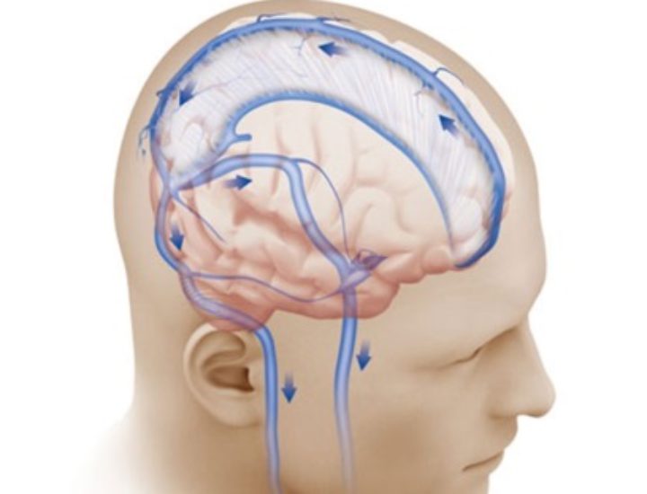 Умеренно выраженная гидроцефалия головного мозга у взрослых лечение