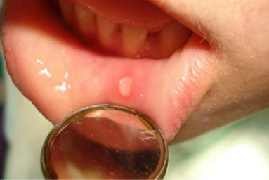 Как выглядит стоматит во рту у взрослых фото симптомы и лечение thumbnail