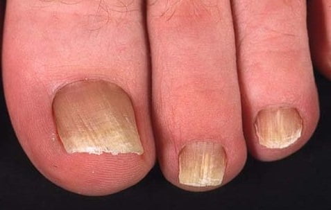 Как вылечить инфекцию ногтях