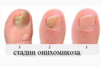 Как вылечить инфекцию ногтях