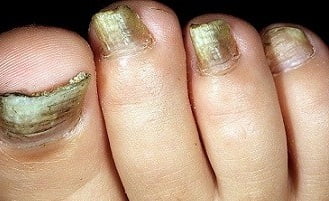 Как вылечить грибок ногтей онихомикоз thumbnail