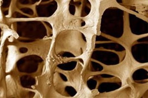 Первые признаки остеопороза у женщин