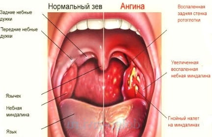 Острая ангина у взрослых симптомы thumbnail