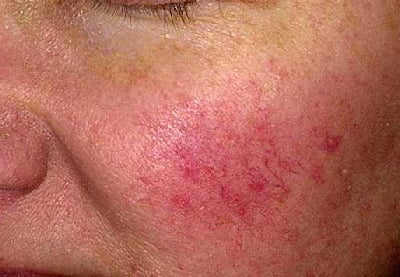 Болезнь кожи лица розацеа лечение
