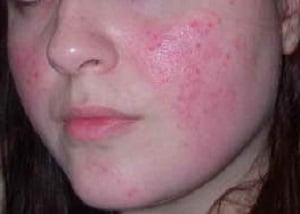Заболевание кожи лица розацеа