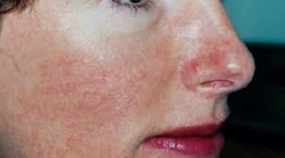 Болезнь кожи лица розацеа