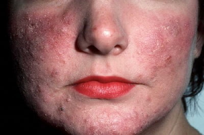 Заболевание кожи лица розацеа