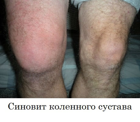 Эхографическая картина синовита коленного сустава лечение