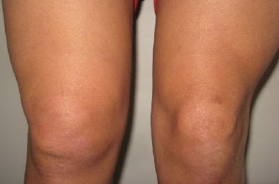 Заболевания коленного сустава лечение синовита