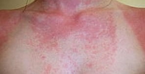 Солнечный дерматит на лице thumbnail