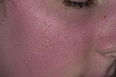 Лечение аллергического солнечного дерматита thumbnail