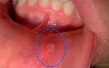 Симптомы стоматита у взрослых фото лечение thumbnail